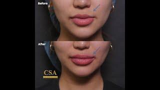 Correcting lip asymmetry And introducing Hollywood spectra for treatment of post acne inflammation