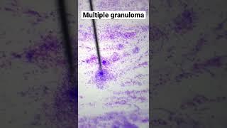 Multiple granuloma on cytology smear (10x view)#Cytology #Pathology