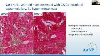 AANP Teaching Rounds - October 23, 2024 - Hereditary Tumor Syndromes Associated with CNS/PNS Tumors