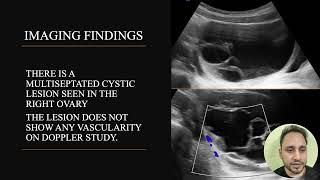 SACHIN SHARMA | Benign Ovarian Cystic Lesions- Case Series