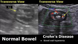 Small Bowel Ultrasound Normal Vs Abnormal Image Appearances | Gastrointestinal Tract (GIT) USG