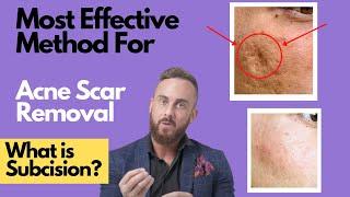 How To Treat DEEP ACNE SCARS | What is SUBCISION?