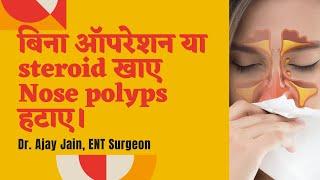 nasal polyp I steroid nasal spray I allergic rhinitis I नाक के बढे हुए मांस का इलाज कैसे करे