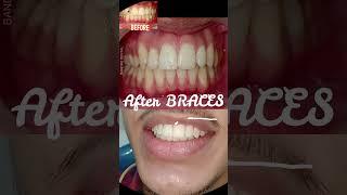 Smile Transformation with Braces #bestdentistindelhi #braces #braces&implants