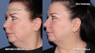 Patient Testimonial on Kybella for Double Chin