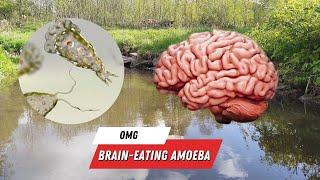 Israel Treats First Living Brain-Eating Amoeba Patient