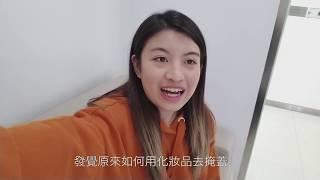 Kinly Beauty 健麗醫美【真實分享 遺傳性眼袋有救！ 免開刀去眼袋療程 】上集