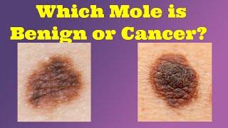 How To Check Your Mole For Skin Cancer | Benign vs Melanoma