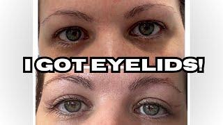 Blepharoplasty Hooded Eye Surgery Healing Process. #blepharoplastysurgery  #hoodedeyes