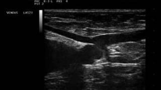 Phlebology- Biosound Esaote MyLab 25 SFJ Venous Ultrasound