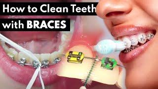 Braces Care Routine |  Water Flosser, Brushing, Rinsing etc.