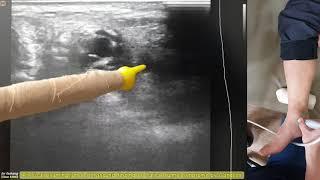 330.(의사용. Physical & US finding) Tarsal tunnel syndrome by Ganglion. 결절종에 의한 족근관 증후군[강찬.정형외과.Chan]