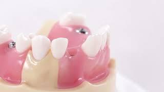 Dentium USA Bone-Level Implant Impression Step By Step Demonstration (Closed Tray Technique)