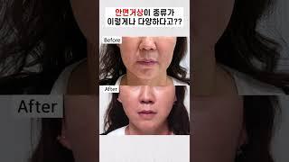 얼굴 처짐에 따라 리프팅 방법 거상술 종류도 달라져야죠!