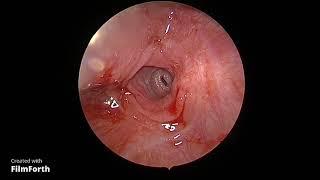 Congenital Esophageal web release and dilatation - Dr Babu A R, JSSAHER Mysuru.