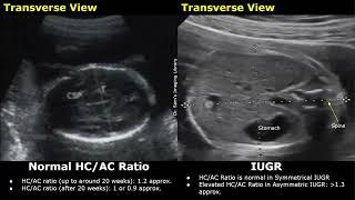 Obstetric Ultrasound Normal Vs Intrauterine Growth Restriction (IUGR) | Placental Insufficiency USG