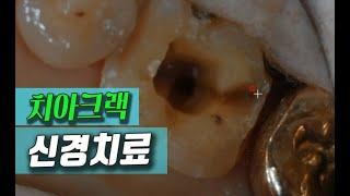 치아크랙 금간치아 신경치료후 크라운치료