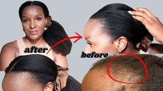 Hair Loss: How to regrow your edges and prevent hair loss | Before and After pregnancy