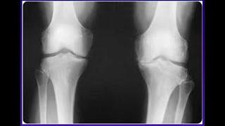 Stem cells for knees, pain or arthritis