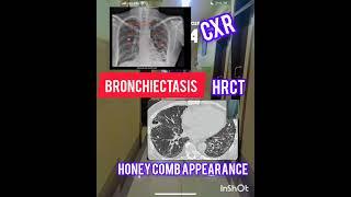 #pulmonology #bronchiectasis #investigations #medicos ‍️