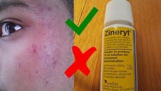 Why I had to stop using Zineryt! The Good and The Bad! (Little Warning when using!)