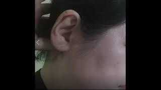 흉쇄유돌근  마사지 sternocleidomastoid massage