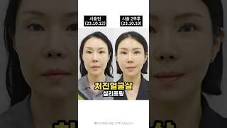 #실리프팅 8개월 후 사진 공개️
