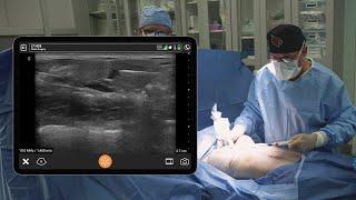 Ultrasound-Guided Breast Fat Grafting