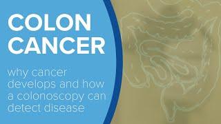 How Colon Cancer Develops - Yale Medicine Explains