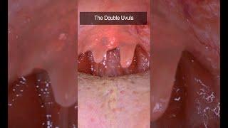 ENT Strange Factoids: Bifid & Double Uvula #shorts @fauquierent