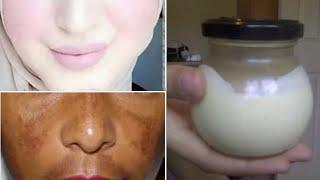 Skin whitening treatment that works 100% / get fair skin naturally