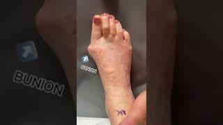 How to Transform a Huge Bunion with an AMI Bunion Procedure