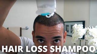 Top 3 Hair Loss Shampoos *DO NOT WASTE YOUR MONEY