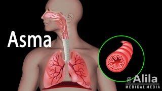 Patología del Asma, Animación. Alila Medical Media Español.