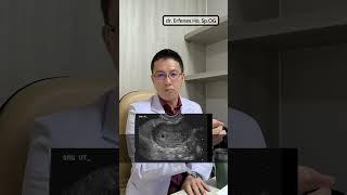 Kantung Kehamilan Normal | dr. Erfenes Ho, Sp.OG