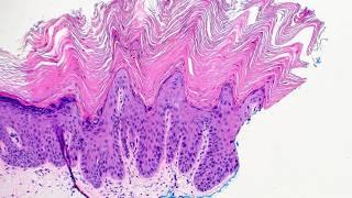 Cute Warty HAK (hypertrophic actinic keratosis) & squamous cell carcinoma (pathology histology)