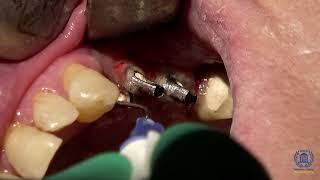 Trattamento perimplantite con laser e Sioxyl+ - Perimplantitis treatment w/ laser and Sioxyl+