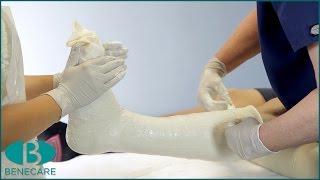 How to Apply a Below Knee Cast Using Plaster of Paris