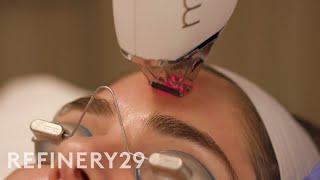 I Got The Moxi Laser and BBL Treatments by a Dr. 90210 Alum | Macro Beauty | Refinery29