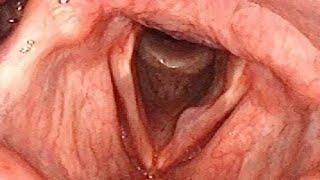 Vocal Cord Cyst Causing Hoarse Voice