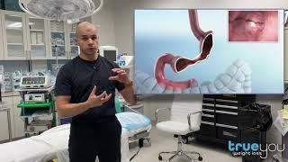 Endoscopic Revision of Sleeve Gastrectomy: explained