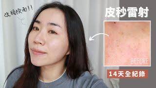 最夯的「皮秒雷射」真的太值得了！14天超真實記錄～斑點、暗沉、毛孔的超級剋星！？ ft.佐登微爾醫美診所