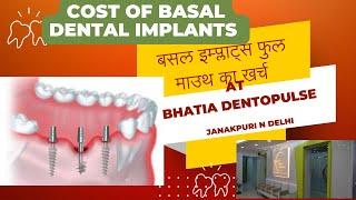 बसल इम्प्लांट्स फुल माउथ का खर्च ,COST OF BASAL IMPLANTS COST-FULL MOUTH ,UPPER ARCH,LOWER ARCH