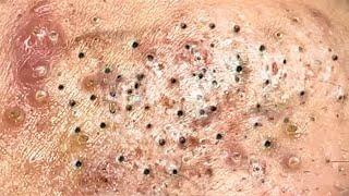 Loan Nguyen Acne Treatment 4264