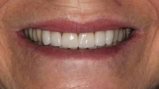 Porcelian Veneers using e.Max in Chicago