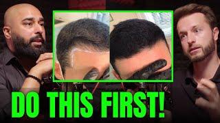 Instantly Double Your Hair Density With Scalp Micro Pigmentation!