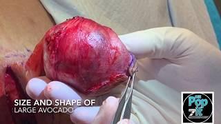 AVOCADO CYST. Gigantic cyst removal size of large avocado. Cyst popped on surgery tray. Excision.