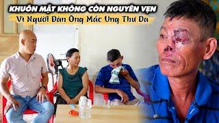 KHUÔN MẶT NGƯỜI ĐÀN ÔNG KHÔNG CÒN NGUYÊN VẸN DO MẮC PHẢI CĂN BỆNH UNG THƯ DA