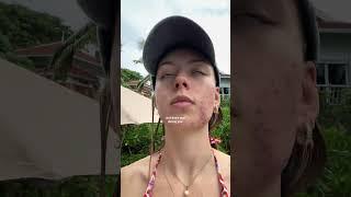 My journey with acne has been LONG   #shorts #short #Liner beauty