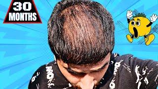 30 months after hair transplant result | Born creator